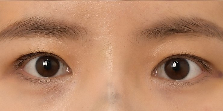 Eye surgery - After
