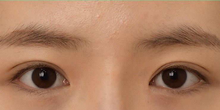 Eye surgery - Before
