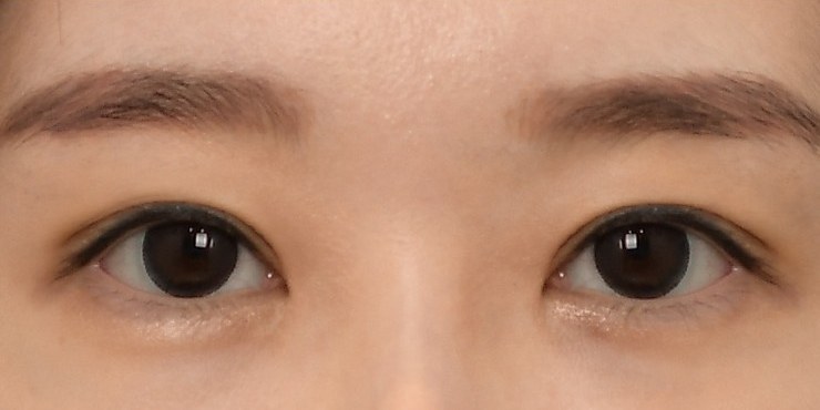 Eye surgery - After