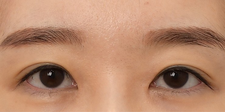 Eye surgery - Before