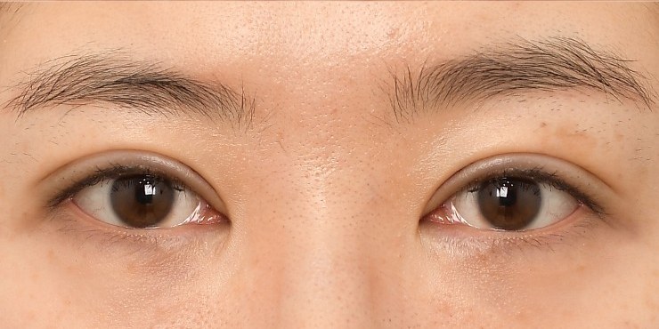 Eye surgery - After