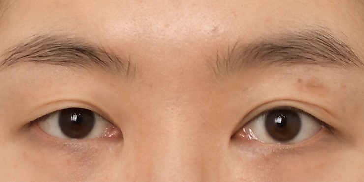 Eye surgery - Before