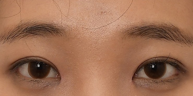 Eye surgery - After