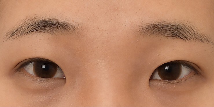 Eye surgery - Before