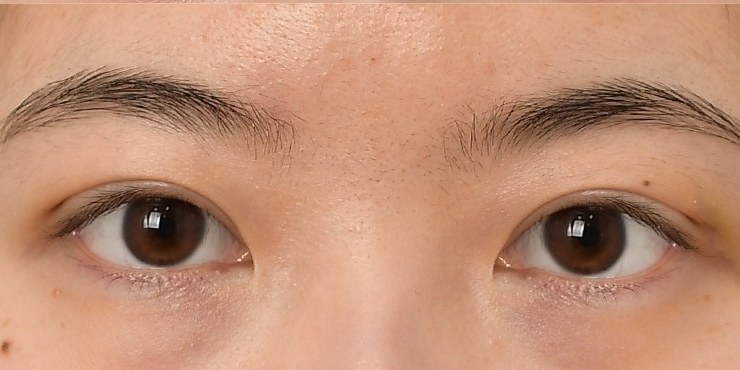 Eye surgery - After