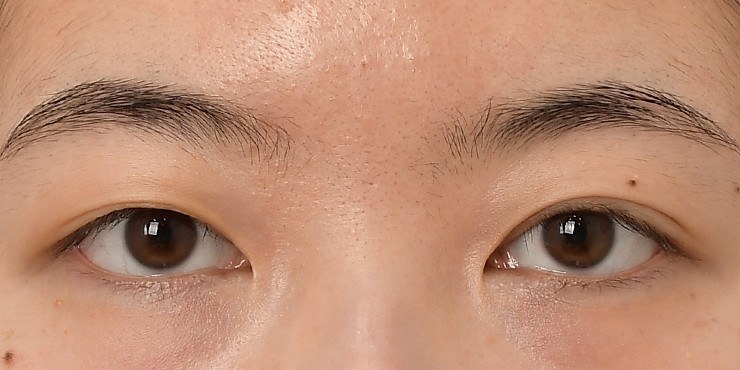 Eye surgery - Before