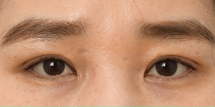 Eye surgery - After