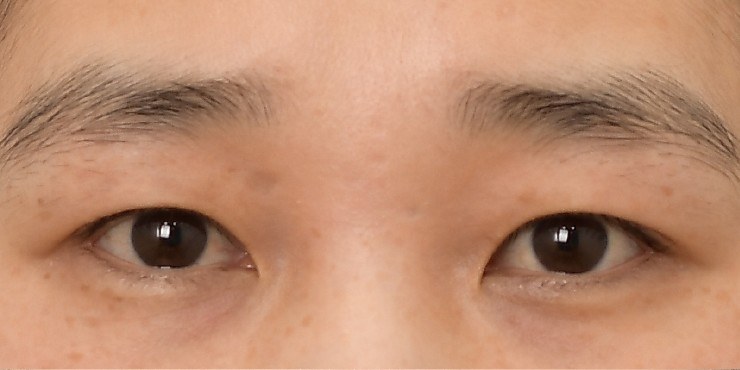 Eye surgery - Before
