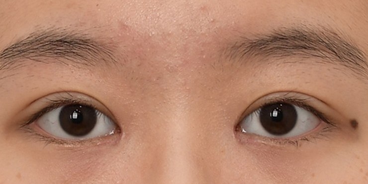Eye surgery - After