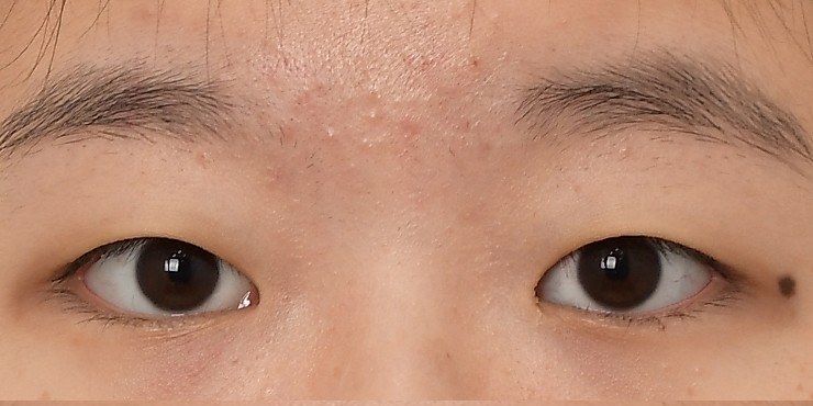 Eye surgery - Before