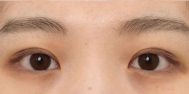 Eye surgery - After