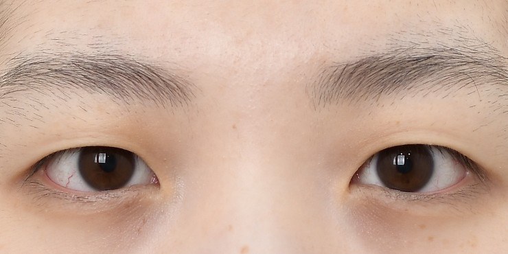 Eye surgery - Before