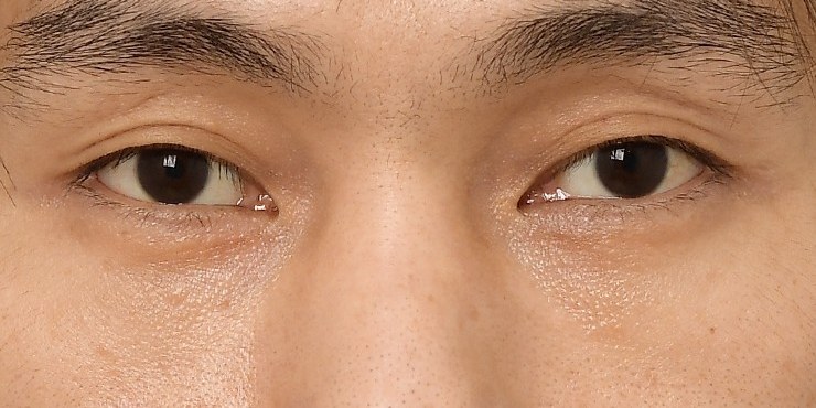 Eye surgery - After
