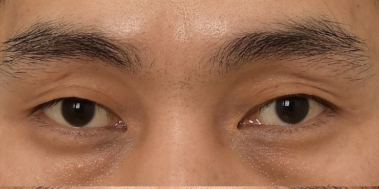 Eye surgery - Before