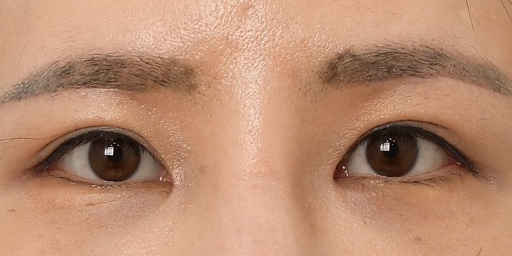 Eye surgery - After