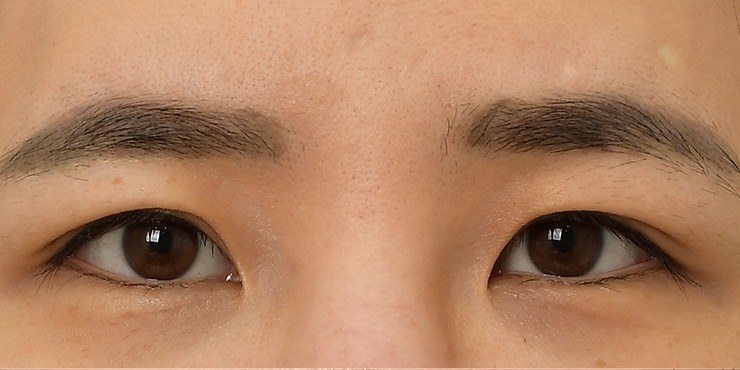 Eye surgery - Before