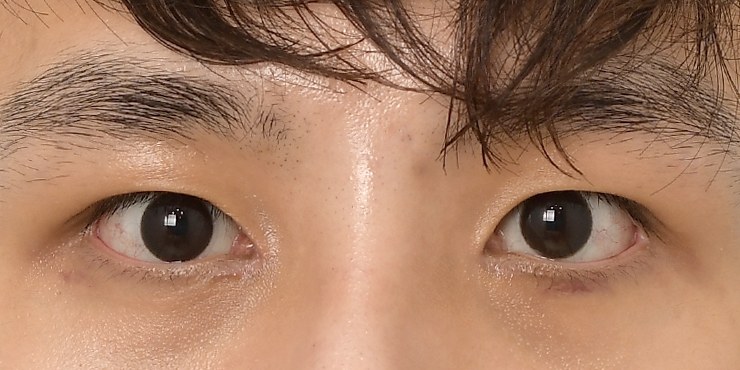 Eye surgery - After