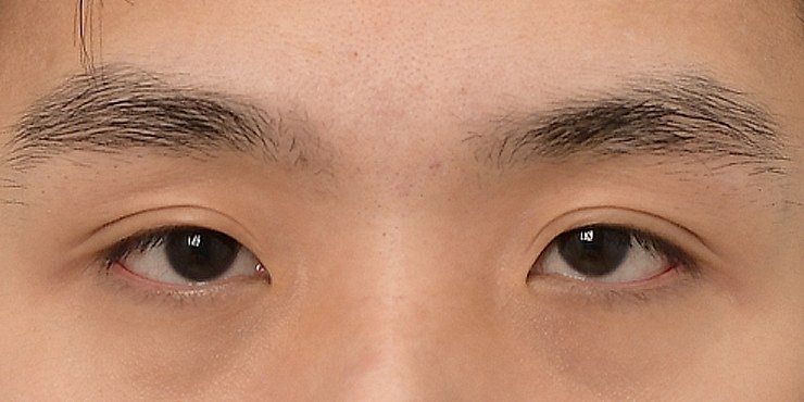 Eye surgery - Before