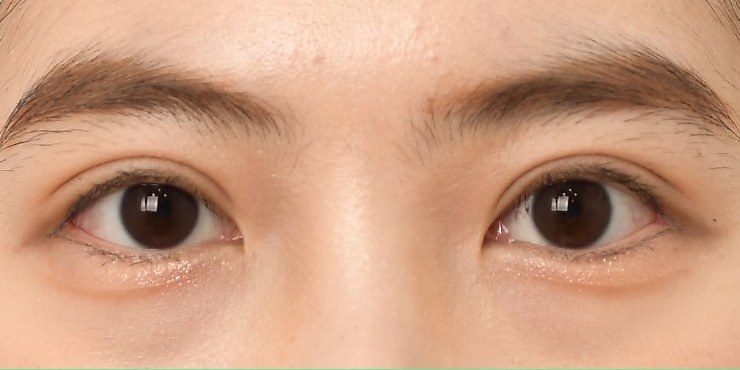 Middle-aged eye surgery - After