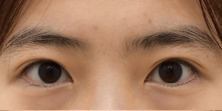 Middle-aged eye surgery - Before
