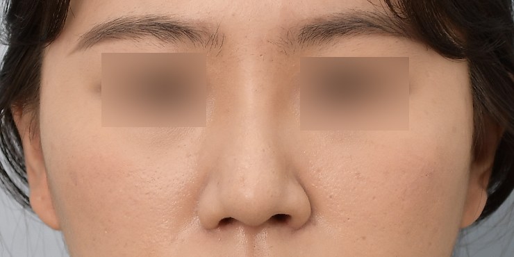 Rhinoplasty - After
