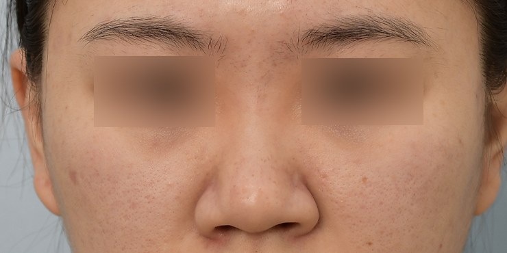 Rhinoplasty - Before