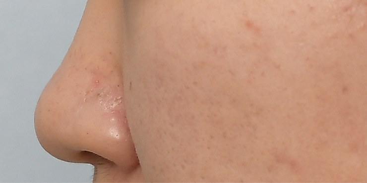 Rhinoplasty - Before