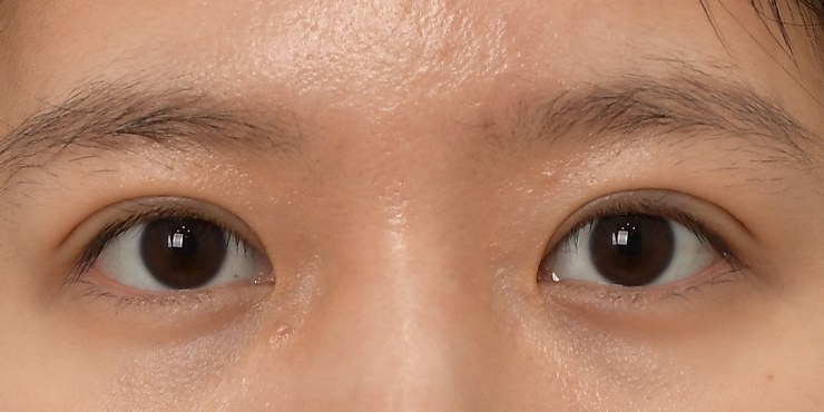 Eye revision - After