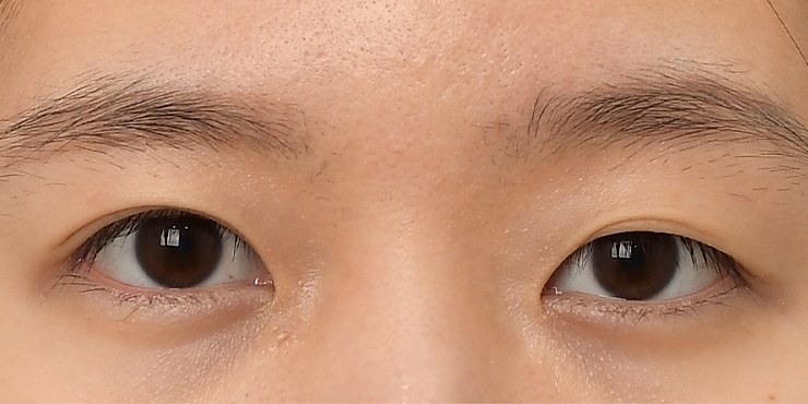 Eye revision - Before