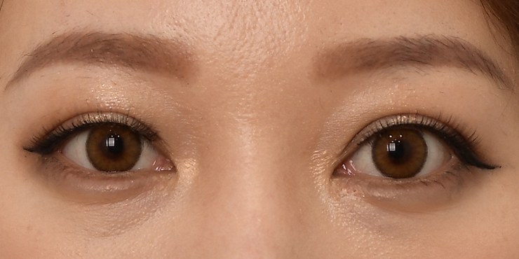 Eye revision - After