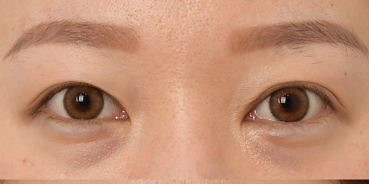 Eye revision - Before