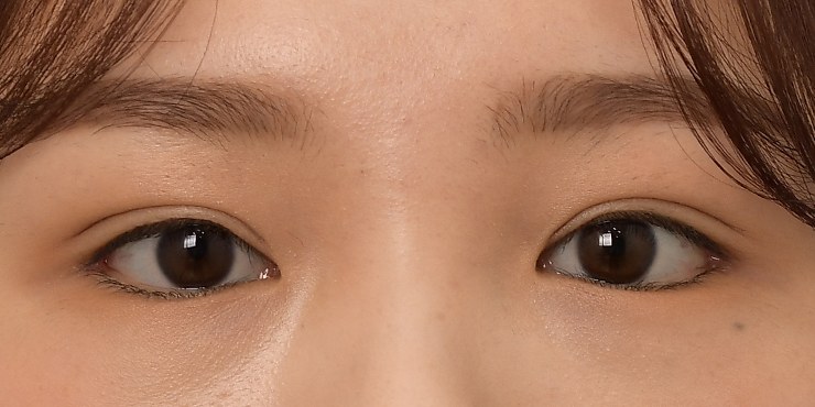 Eye revision - After