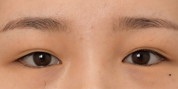 Eye revision - Before