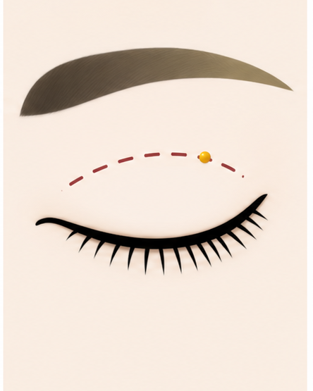 Procedure stage visual 02